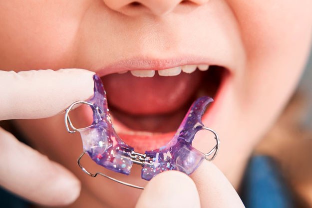 Aparato de ortopedia maxilar removible de acrílico morado con brillos, sostenido frente a la boca de un niño